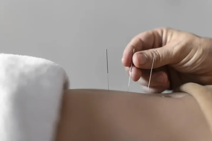 Dry needling treatment delivered during an in-home visit