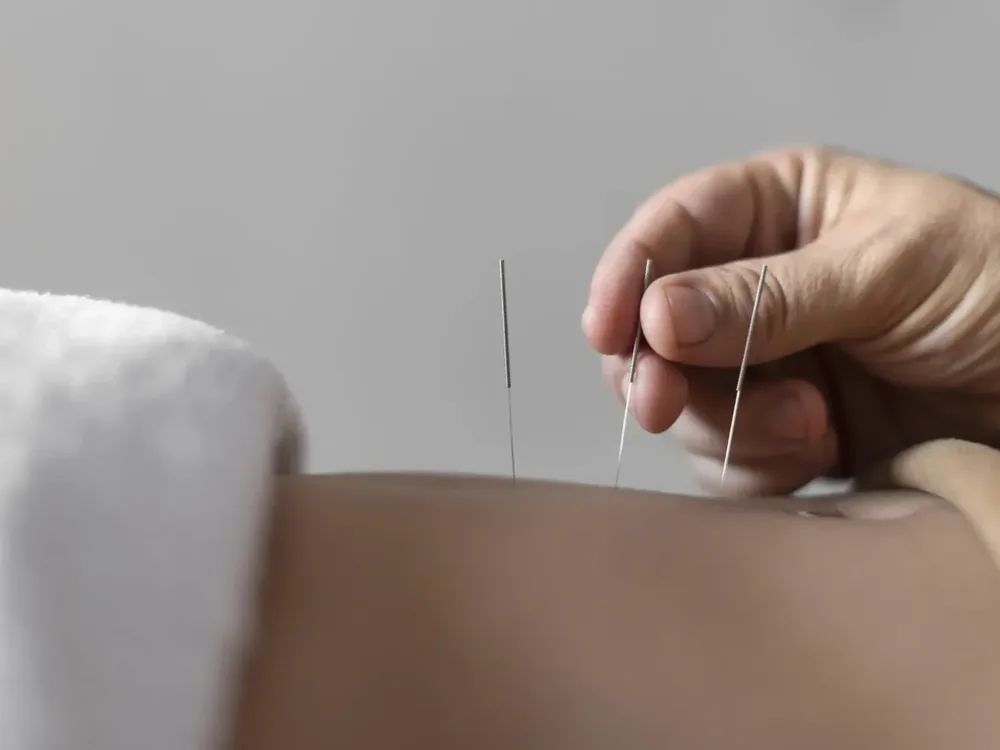 Clinician performing dry needling trigger-point treatment